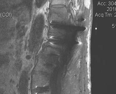 MRI Gadolinium Post Operative Discitis T1